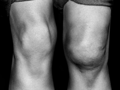 Swelling in knee joints